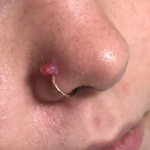How to Get Rid of a Piercing Bump: A Simple Guide