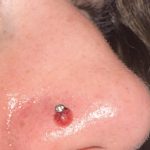 Can a Nose Piercing Infection Kill You