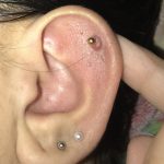 Do Piercing Bumps Go Away