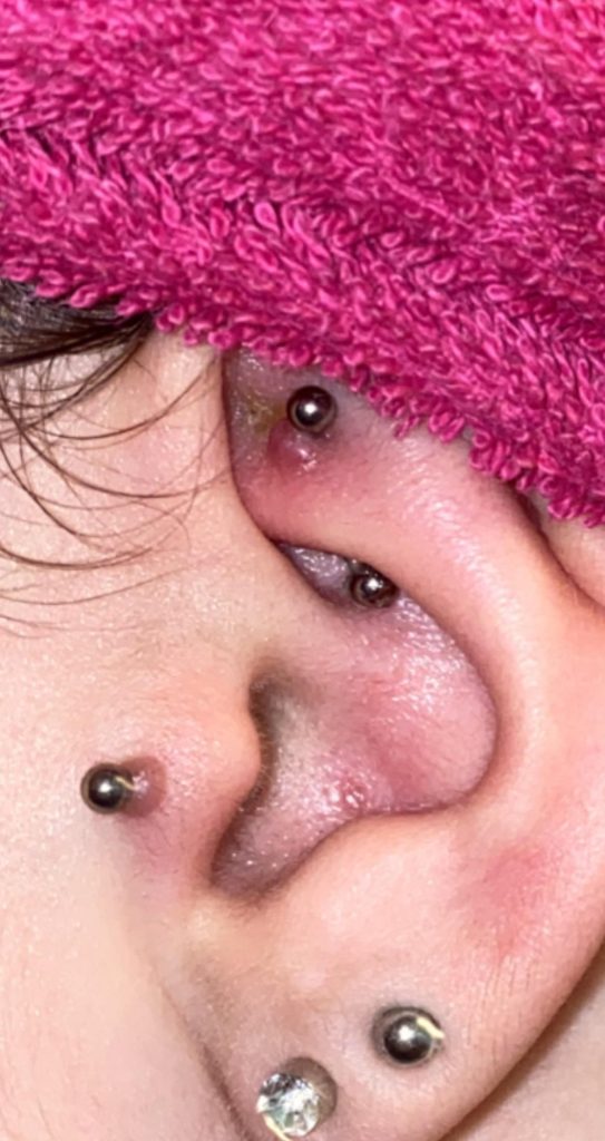 How to Calm a Piercing Bump