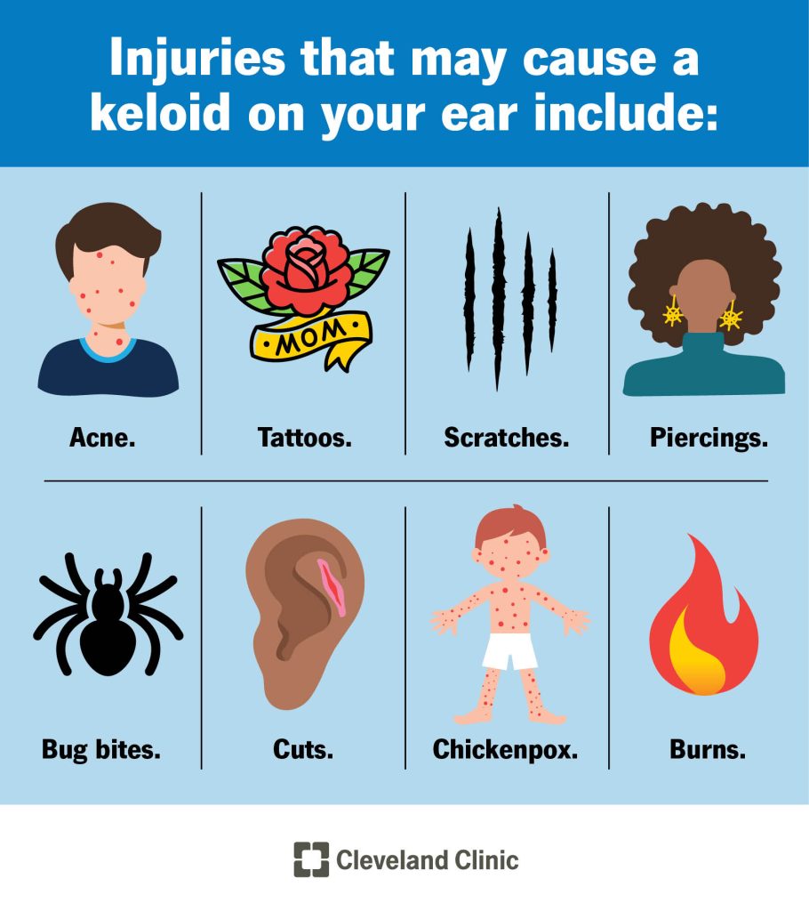 How to Get Rid Keloids on Piercings