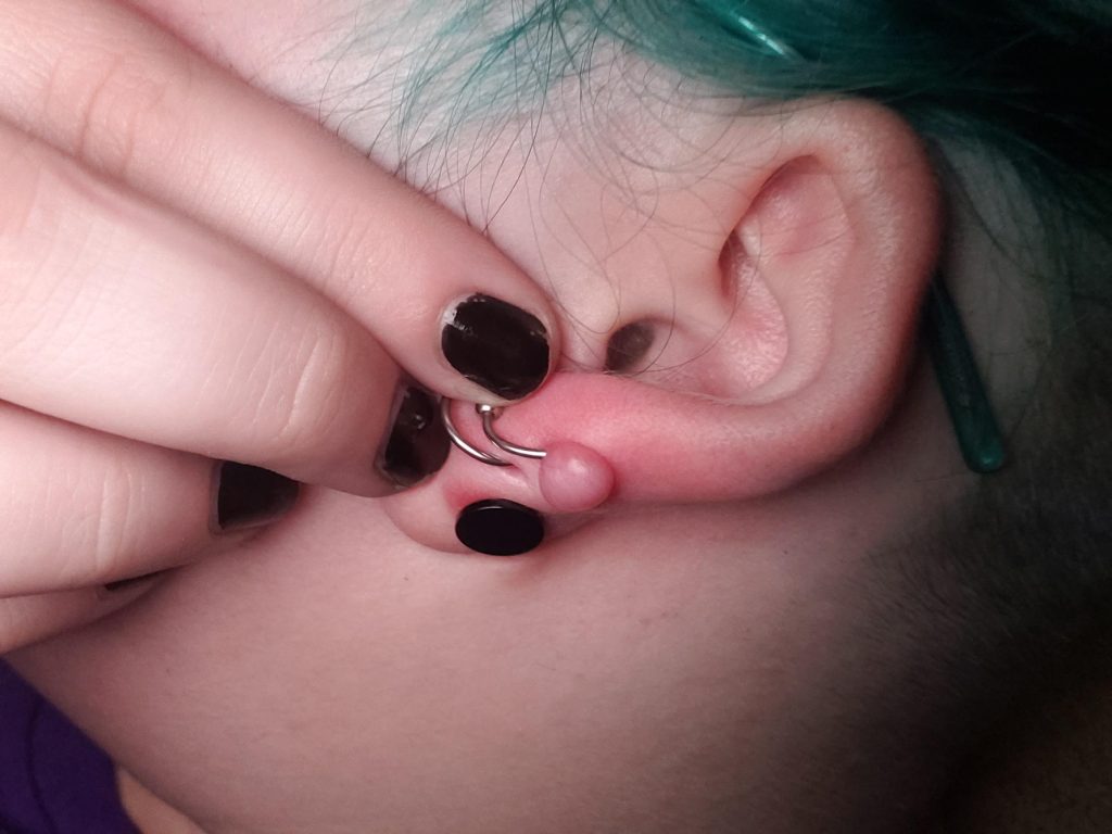 How to Get Rid of a Keloid on a Piercing