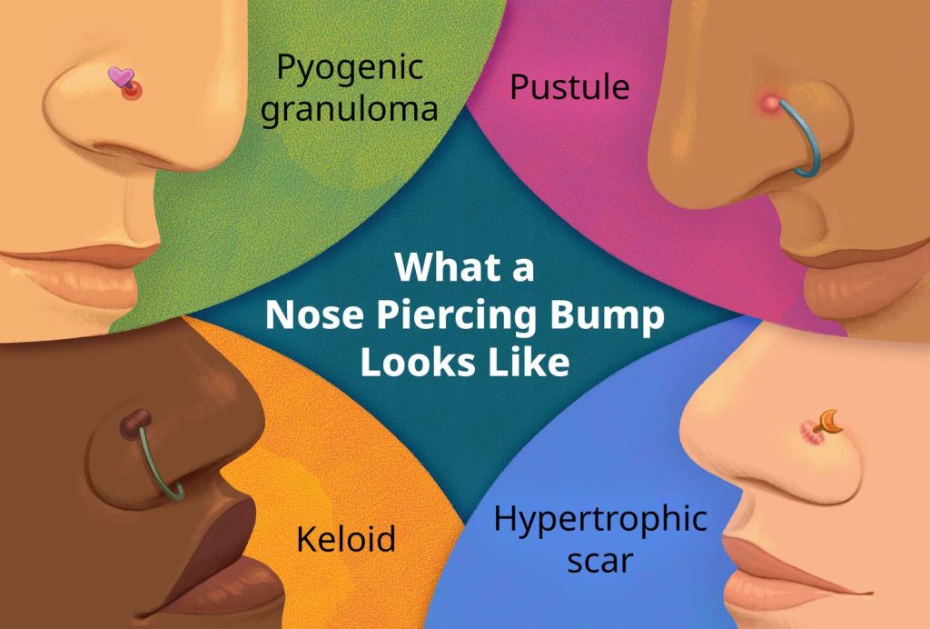 How to Get Rid of Bump on Piercing
