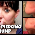 How to Get Rid of Keloid on Nose Piercing