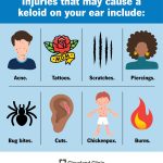 How to Get Rid of Keloids from Piercings