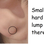 How to Get Rid of Lump in Earlobe Piercing