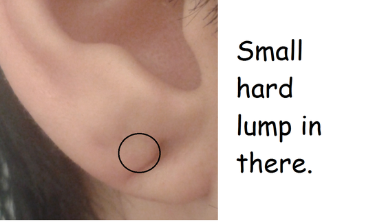 How to Get Rid of Lump in Earlobe Piercing