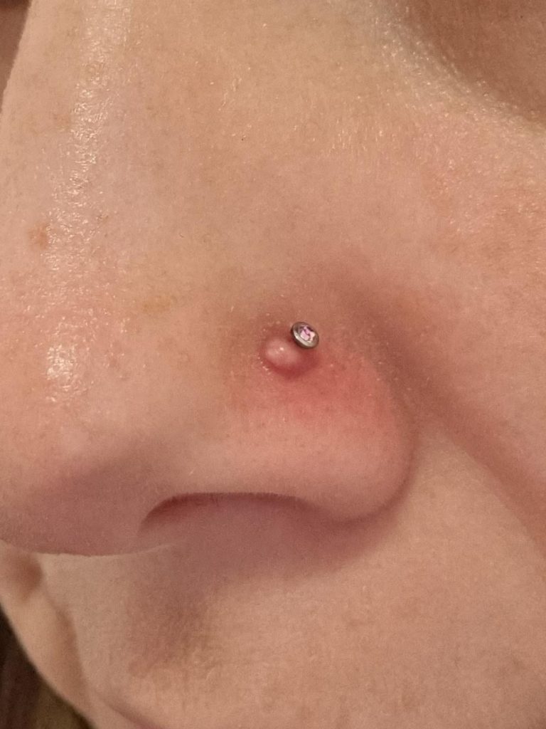 How to Get Rid of Nose Piercing Bump