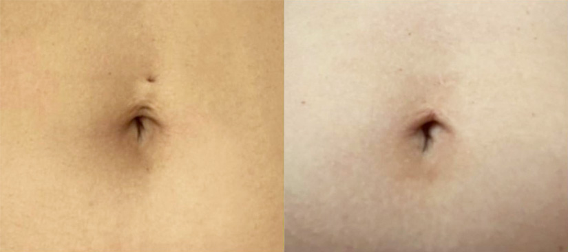 How to Remove Belly Button Piercing