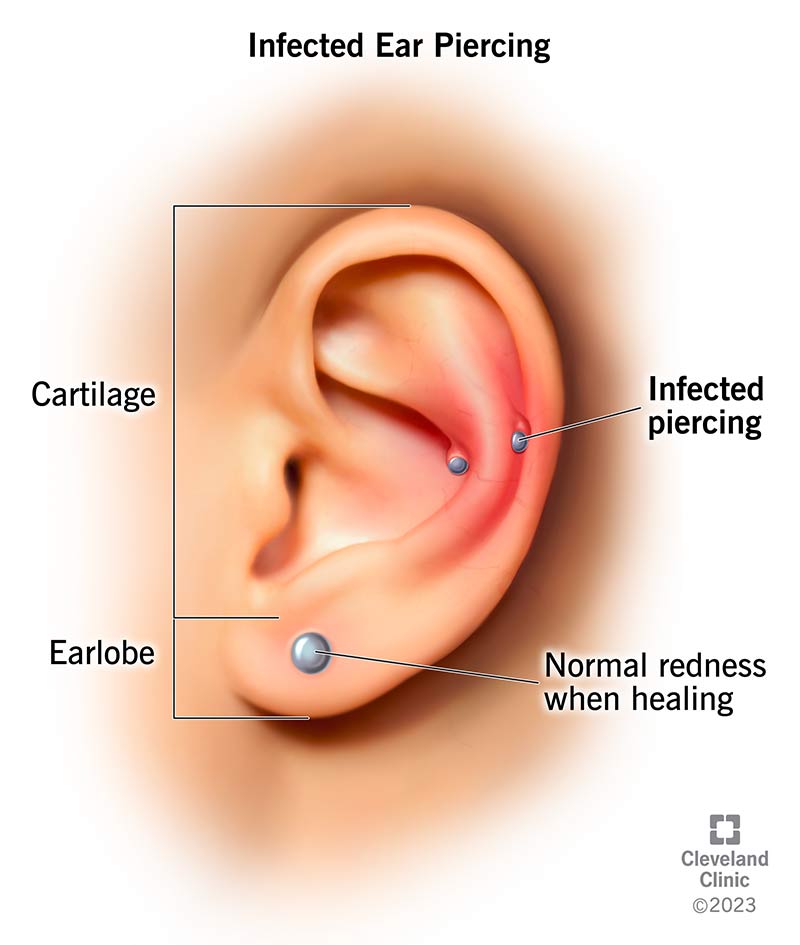 How to Treat an Infected Ear Piercing