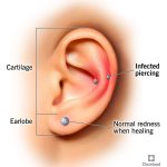 How to Treat an Infected Piercing