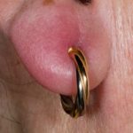 What Does Infected Earlobe Piercing Look Like