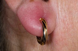 What to Do If Ear Piercing is Infected