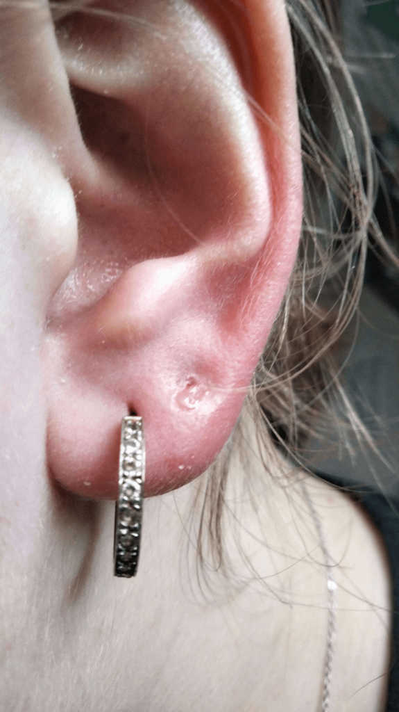 Why are My Ears Itching So Bad Months After Piercing