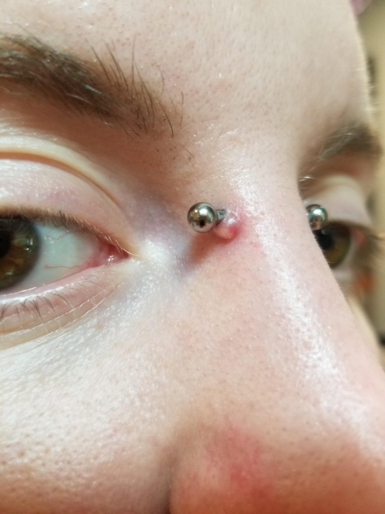Will a Bridge Piercing Bump Go Away