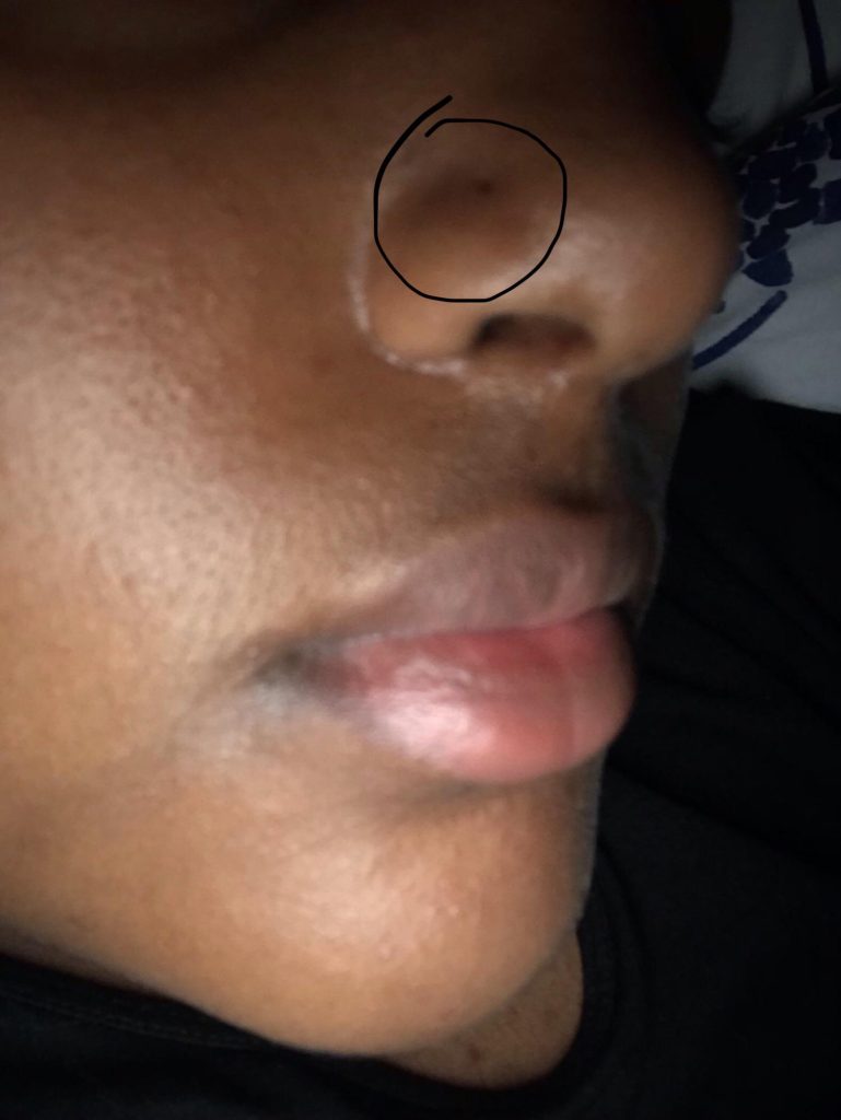 Will Nose Piercings Close
