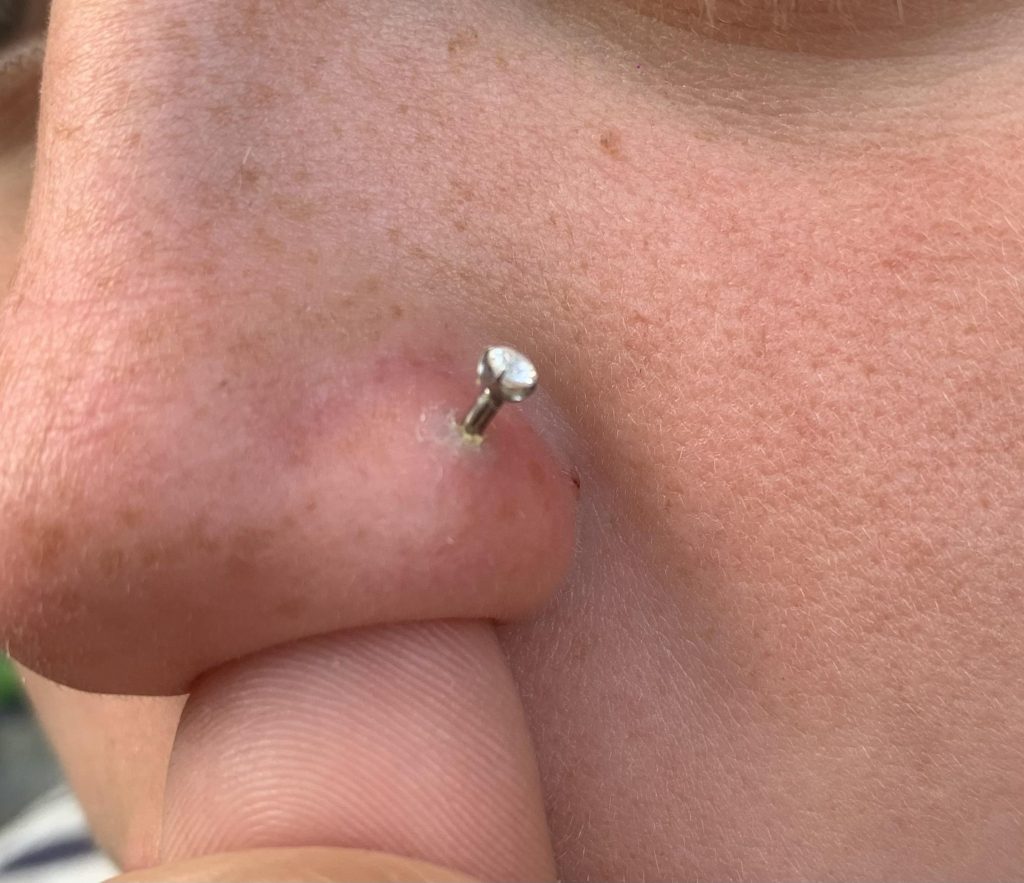 Why Is There A White Ring Around My Nose Piercing