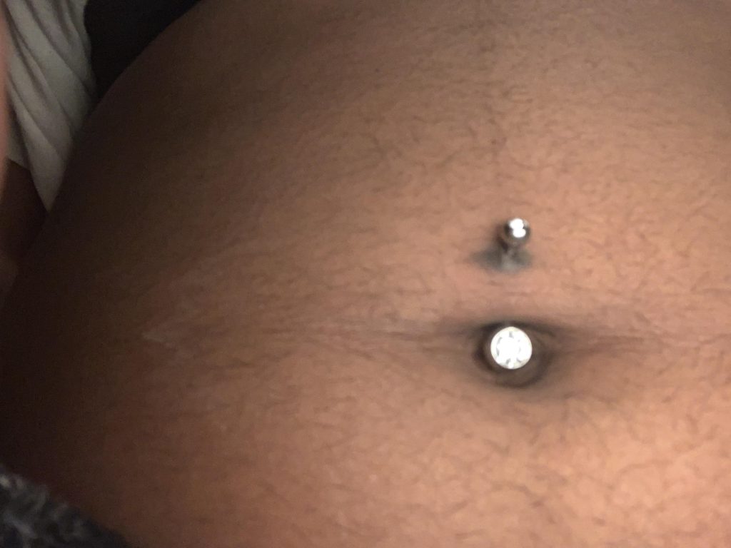 How To Get Rid Of Hyperpigmentation Around Belly Button Piercing