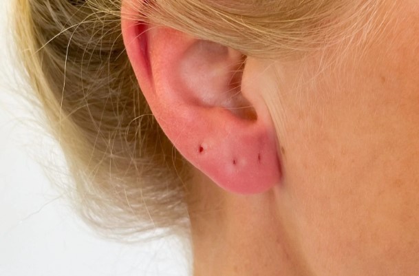 Why Does My Earring Hole Hurt After Years